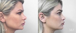Revision Rhinoplasty