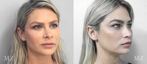 Revision Rhinoplasty