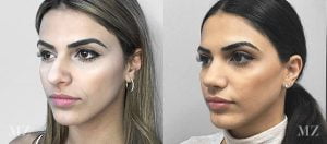Primary Rhinoplasty Before & After