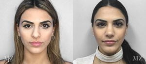 Primary Rhinoplasty Before & After