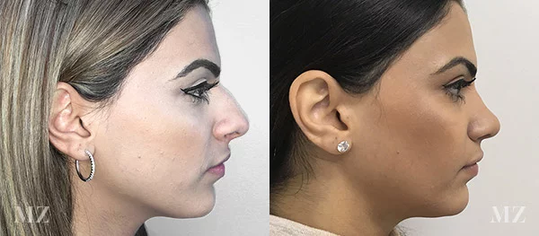 Primary Rhinoplasty Before & After