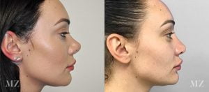 Primary Rhinoplasty Before & After