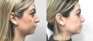 Primary Rhinoplasty Before & After