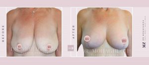 breast lift, breast lift sydney, breast lifting operation surgery, breast lift cost, mastopexy cost, mastopexy price, mastopexy lift, boob lift sydney, boob lift price, boob lift operation, boob lift after pregnancy, breast lift double bay, breast reduction sydney, breast reduction surgery, breast reduction surgery cost, breast reduction, breast reduction surgery cost sydney, breast reduction procedure, plastic surgery breast reduction, breast reduction sydney., breast lift sydney., breast reduction double bay, breast reduction Dr Zacharia, breast reduction Dr Michael Zacharia, breast lift Dr Zacharia, breast lift Dr Michael Zacharia, breast reduction and lift, breast reduction and lift sydney, breast lift and reduction sydney, breast lift and reduction cost, breast lift and reduction double bay, breast reduction and lift cost, breast reduction and lift double bay,