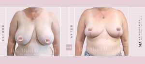 breast lift, breast lift sydney, breast lifting operation surgery, breast lift cost, mastopexy cost, mastopexy price, mastopexy lift, boob lift sydney, boob lift price, boob lift operation, boob lift after pregnancy, breast lift double bay, breast reduction sydney, breast reduction surgery, breast reduction surgery cost, breast reduction, breast reduction surgery cost sydney, breast reduction procedure, plastic surgery breast reduction, breast reduction sydney., breast lift sydney., breast reduction double bay, breast reduction Dr Zacharia, breast reduction Dr Michael Zacharia, breast lift Dr Zacharia, breast lift Dr Michael Zacharia, breast reduction and lift, breast reduction and lift sydney, breast lift and reduction sydney, breast lift and reduction cost, breast lift and reduction double bay, breast reduction and lift cost, breast reduction and lift double bay,