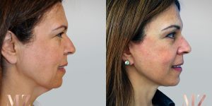 facelift before after