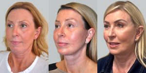 facelift before after