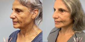 facelift before after