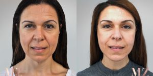 facelift before after