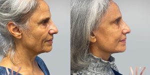 facelift before after