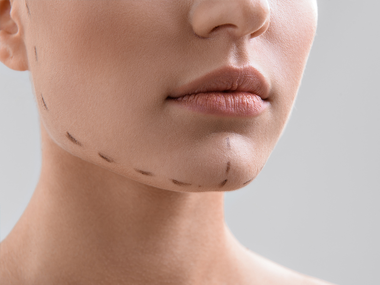 Chin Implant Markings on Face