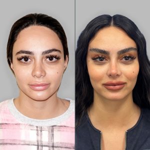 Cat eye brow lift patient before and after