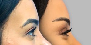 Brow mid-face suspension lift patient before and after