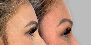 Brow lift patient before and after