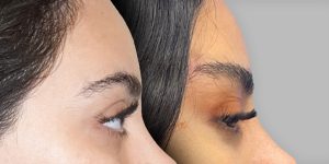 Cat eye brow lift patient before and after