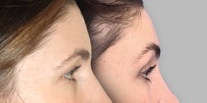 Brow lift patient before and after